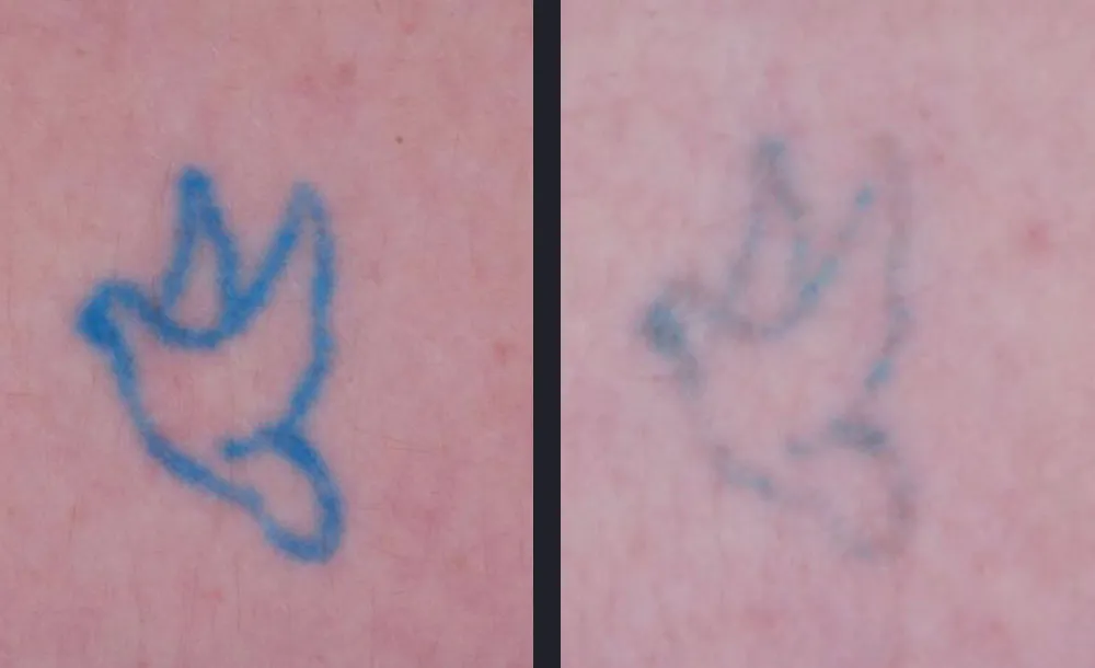 Dermale Langzeitwirkung - Polynucleotide Cellular Biostimulation in Warendorf | AS Skin & Medical Aesthetics