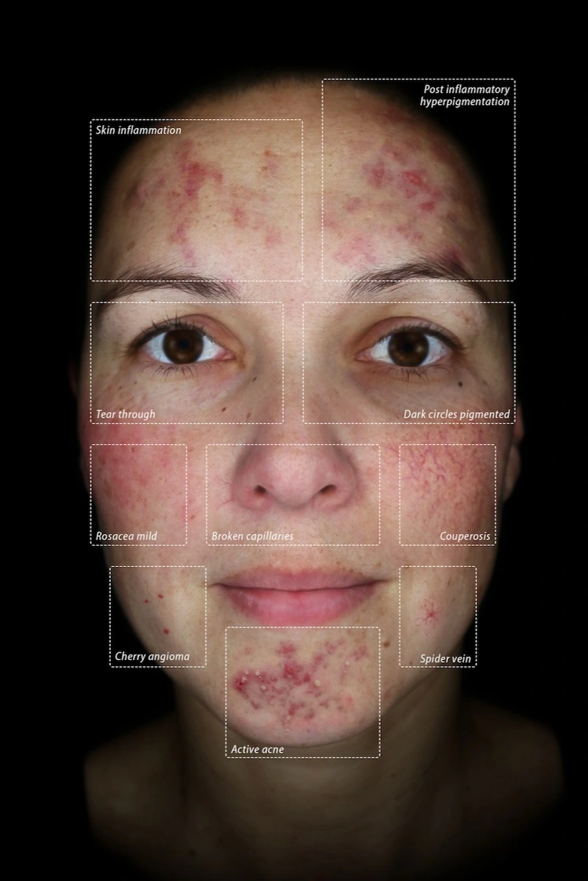 Vascular Patterns & Erythema