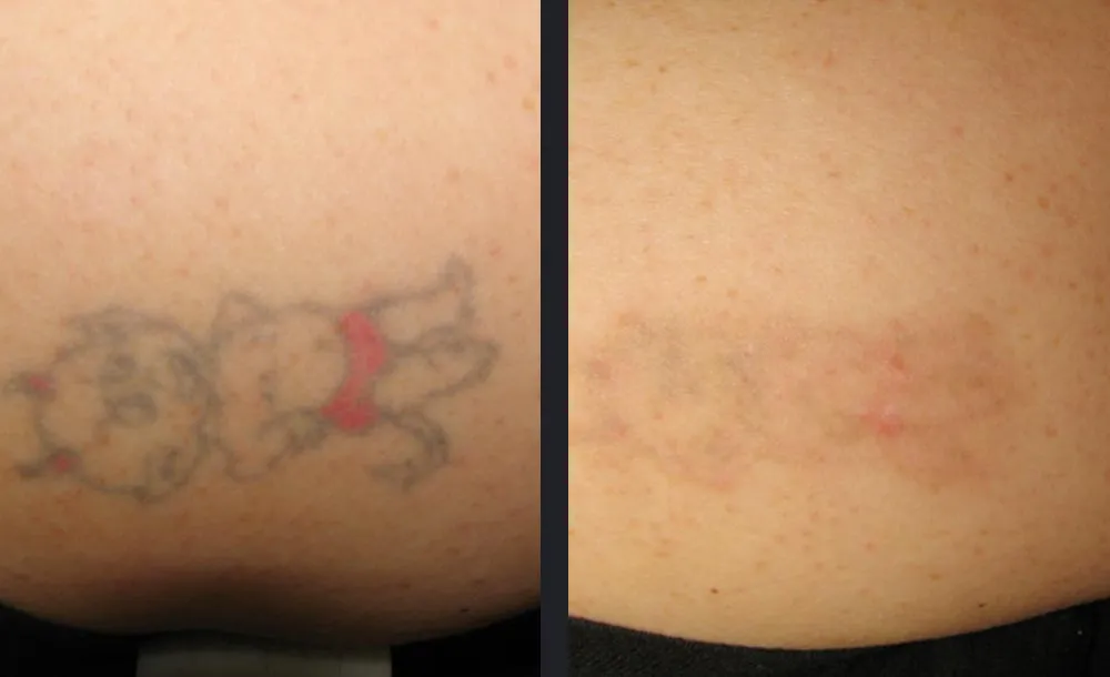 Tiefenmessung - Permanent Laser Hair Removal