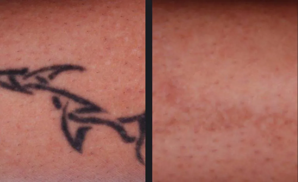 Mikro-Intervention - Permanent Laser Hair Removal