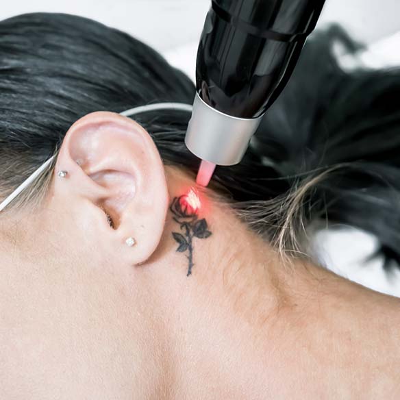 Candela Laser Therapy
